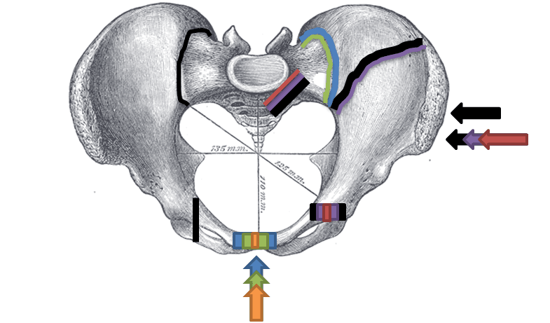 Superior-view diagram of the pelvis showing the force directions that produce the different pelvic ring fracture patterns.