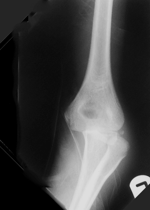 Preoperative anteroposterior radiograph of the elbow revealing fracture lateral condyle in association with posterolateral dislocation of elbow.