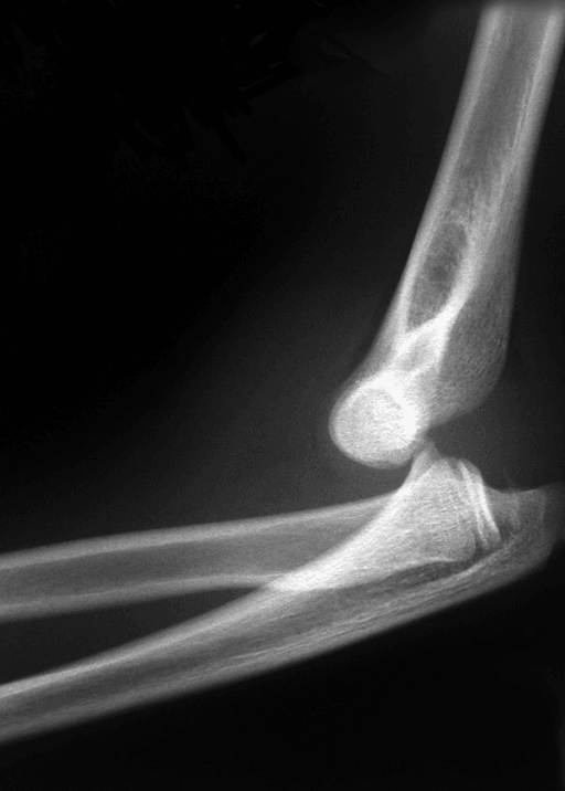 Preoperative lateral radiograph of the elbow showing the displaced lateral condyle fracture with posterolateral dislocation.