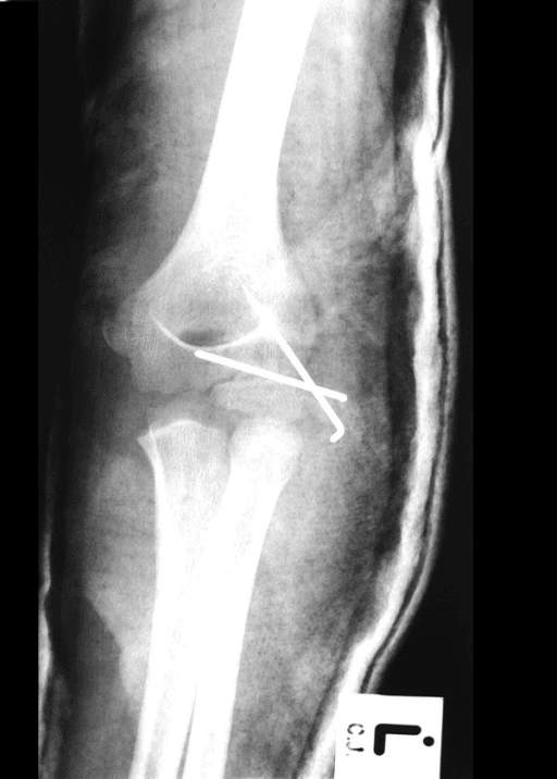 Postoperative anteroposterior radiograph of the elbow revealing internal fixation of the lateral condyle fracture with the help of 2 K-wires. The elbow dislocation was reduced first by closed techniqu