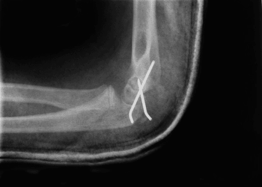 Postoperative lateral radiograph of the elbow revealing internal fixation of the lateral condyle fracture with the help of 2 K-wires.