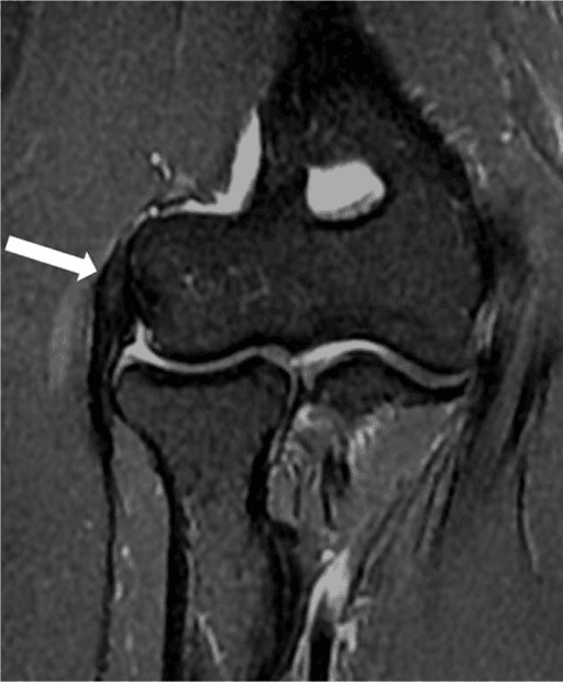 Coronal fat-suppressed T2-weighted MRI of the elbow with an arrow marking a small focus of high signal in the common extensor tendon.