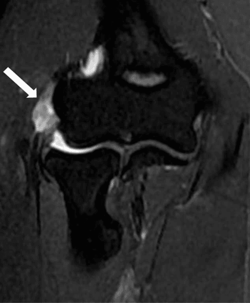 Coronal fat-suppressed T2-weighted MRI of the elbow with an arrow marking diffusely bright signal in the common extensor tendon.