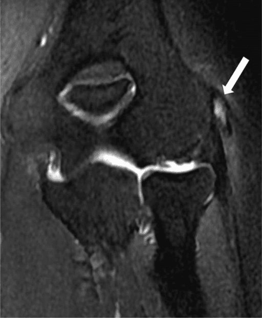 Coronal fat-suppressed T2-weighted MRI of the elbow with an arrow indicating moderate focal high signal in the common extensor tendon.