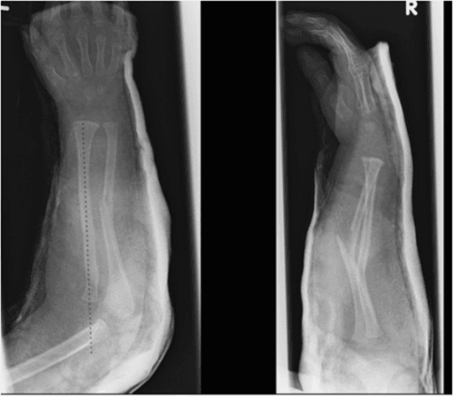 Elbow radiograph taken through plaster showing the radial head displaced anteriorly relative to the capitellum.