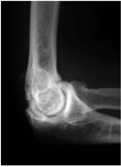 Lateral elbow radiograph showing osteophytes at the radial head and anterior and posterior ulnohumeral joint margins.