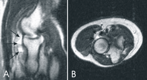 Sagittal T2-weighted MRI of the elbow showing a bright lobulated cystic lesion anterior to the radiocapitellar joint.