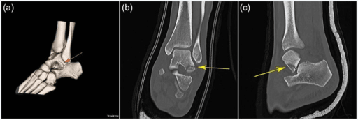 Multiplanar CT imaging of lateral process talus fracture