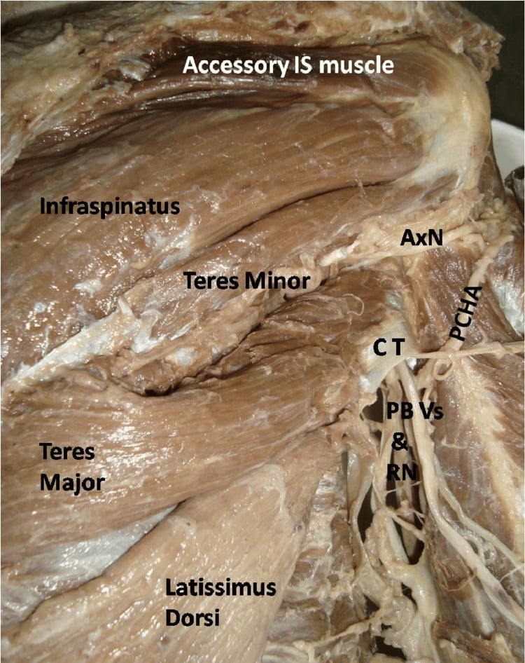 Cadaveric dissection showing the latissimus dorsi and teres major conjoint tendon beside the radial nerve