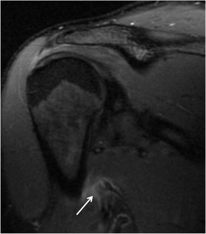 Coronal MRI showing a grade IIIA latissimus dorsi and teres major tear with retraction and surrounding edema