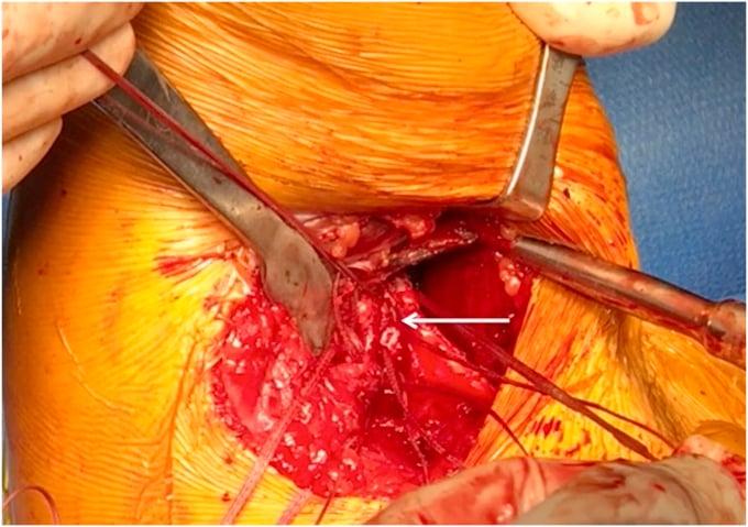 Posterior axillary operative exposure for fixation of latissimus dorsi tendon to the humerus