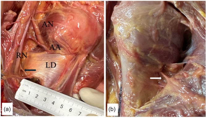 Anterior and posterior cadaveric views of neurovascular structures adjacent to latissimus dorsi and teres major