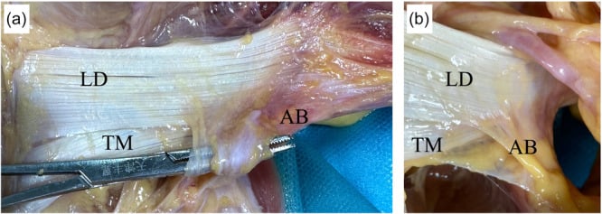 Cadaveric anterior and side views of the aponeurotic band between triceps and latissimus dorsi