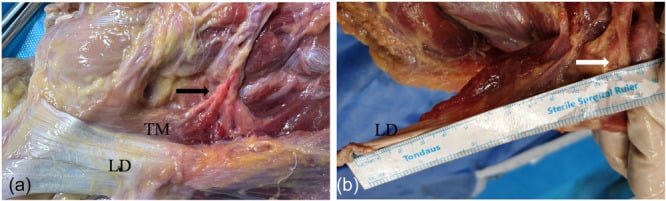 Cadaveric views of the lower subscapular and thoracodorsal pedicles entering teres major and latissimus dorsi