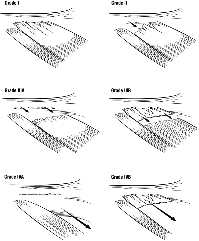 Illustrated grading system for latissimus dorsi and teres major tears