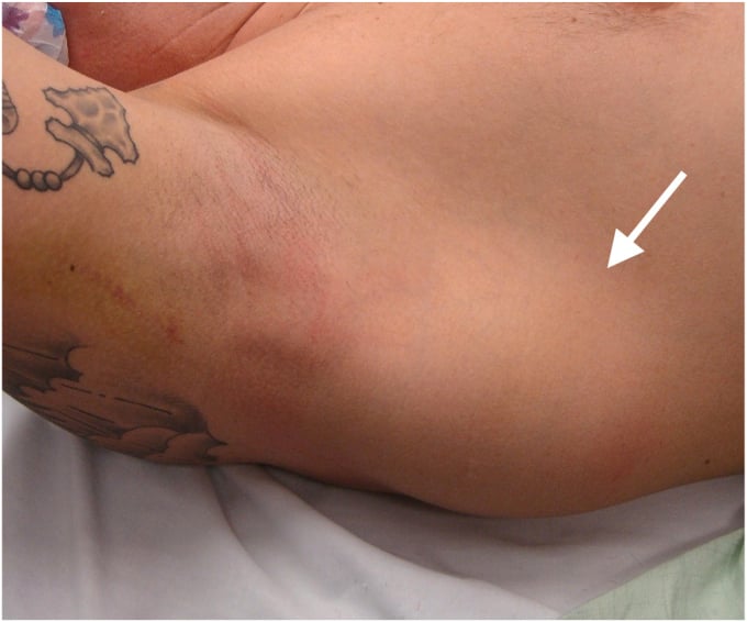 Clinical photograph showing hematoma and swelling of the posterior axillary fold following a latissimus dorsi tear