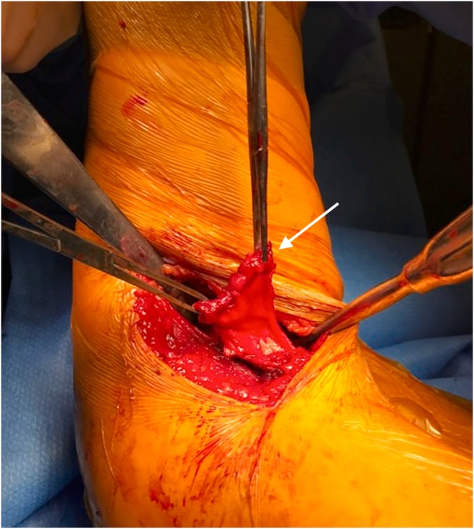 Posterior axillary approach exposing and retrieving the retracted latissimus dorsi tendon