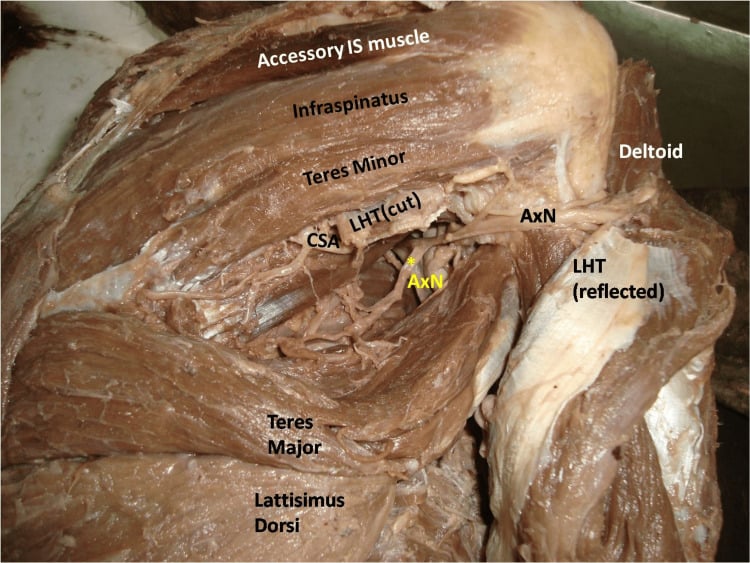 Cadaveric posterior shoulder dissection showing teres major, latissimus dorsi and axillary nerve