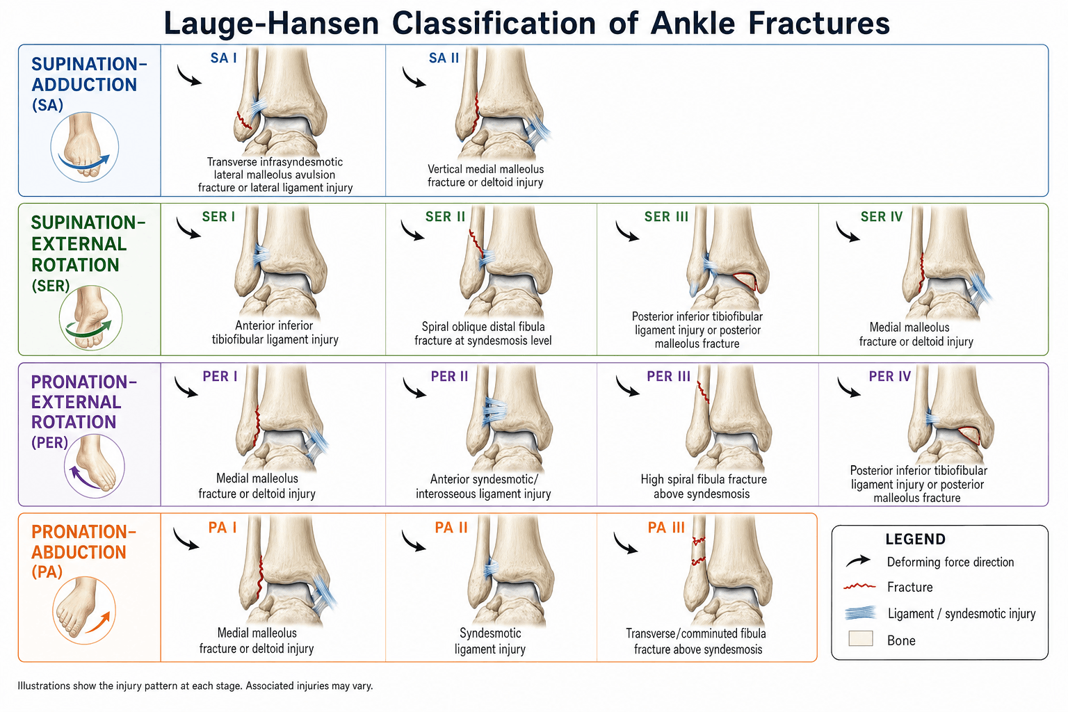 Lauge-Hansen Classification of Ankle Fractures