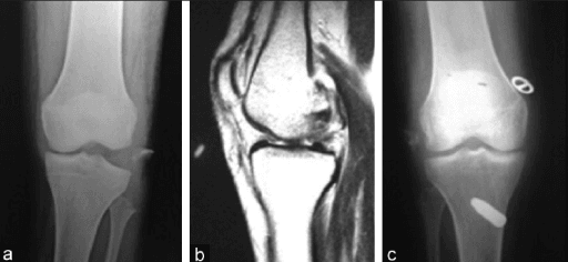 Fibular head avulsion fracture (arcuate sign) on X-ray and MRI