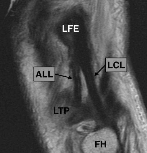 Coronal MRI showing normal LCL anatomy