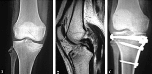 Multiligament knee injury with surgical reconstruction