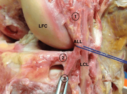 Intraoperative photograph showing LCL and lateral knee anatomy