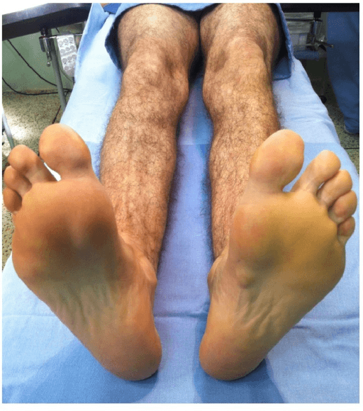 Clinical photograph of both soles of the feet; fullness and a mass are visible over the medial longitudinal arch of the left foot
