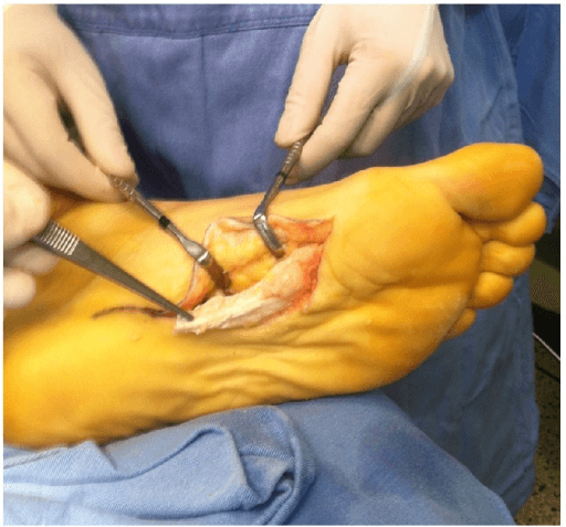 Intraoperative photograph of a plantar approach to the sole exposing pale fibrous tissue of the plantar aponeurosis held by surgical instruments