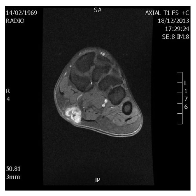 Axial post-contrast MRI showing an enhancing plantar fascial nodule