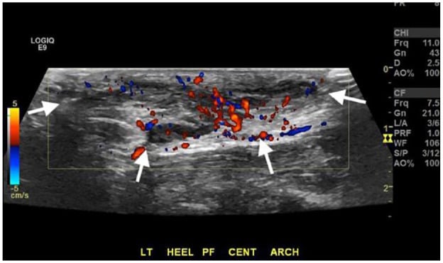 Baseline ultrasound of a recurrent plantar fibroma with Doppler hyperaemia