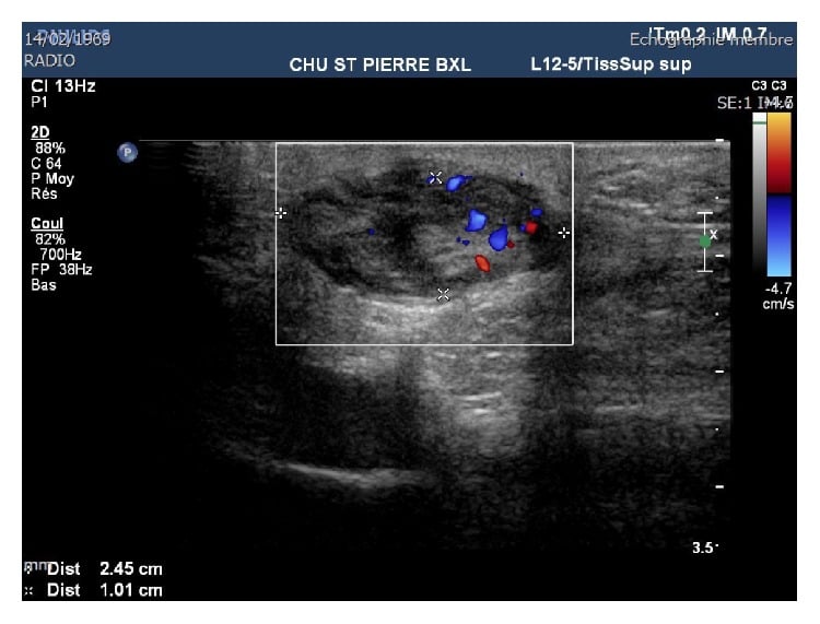 Colour Doppler ultrasound of a hypoechoic plantar fascial nodule