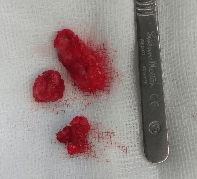 Excised plantar fibromatosis nodules after fasciectomy