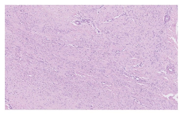 Low-power histology of a fibroblastic plantar nodule