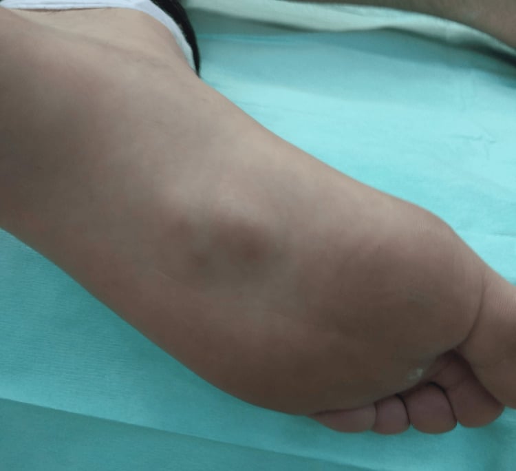 Close-up of multiple nodules along the medial plantar arch