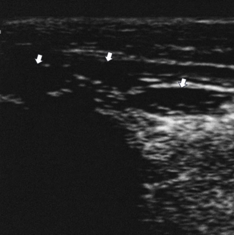 Ultrasound showing three fusiform hypoechoic nodules in the plantar fascia