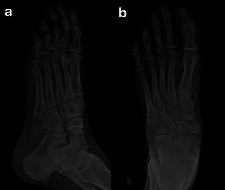 Oblique and dorsoplantar radiographs without osseous abnormality