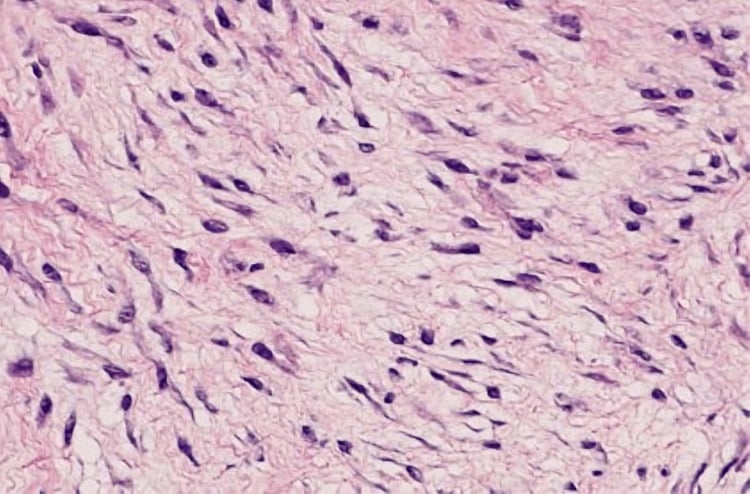 Histology showing fibrocytes and collagen in plantar fibromatosis