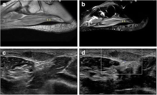 MRI composite showing fusiform thickening of the distal plantar fascia
