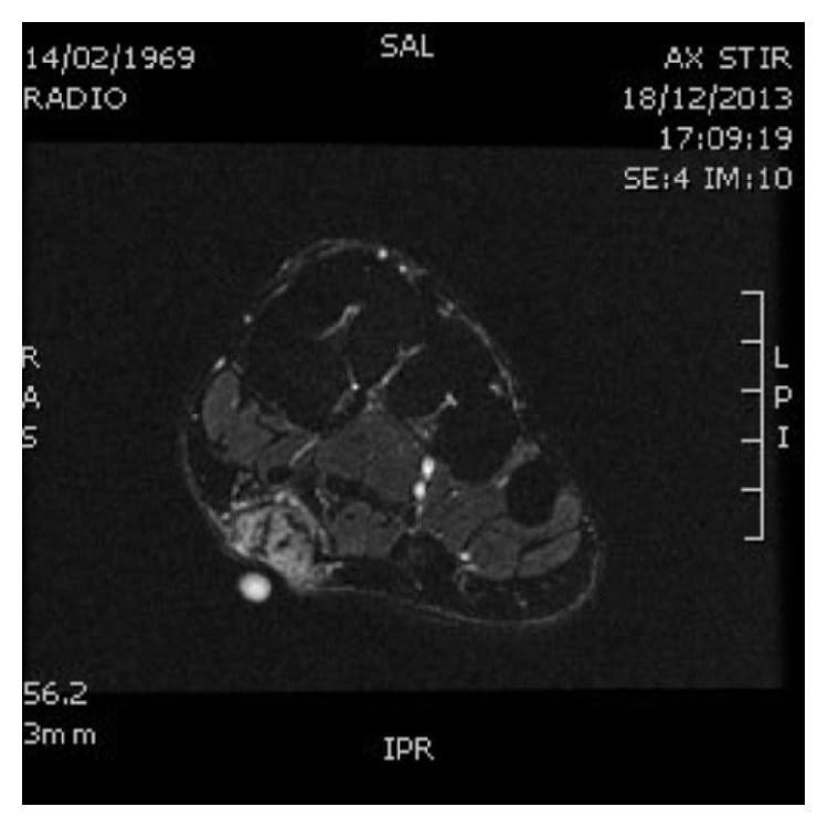 Fat-suppressed proton-density MRI showing a plantar fibroma