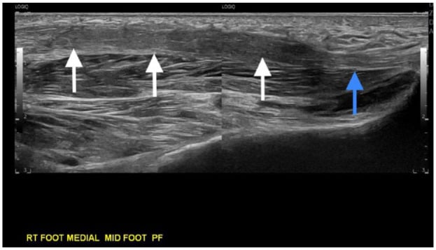 Twelve-month ultrasound after collagenase treatment