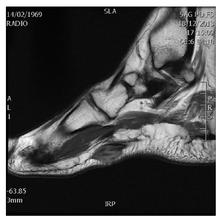 Sagittal T1 MRI showing a low-signal plantar fascial nodule