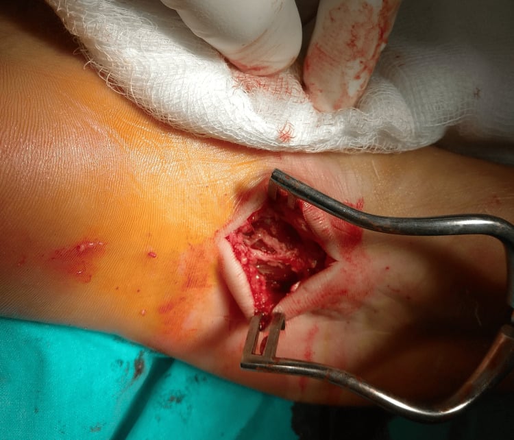 Intraoperative C-shaped plantar exposure during partial fasciectomy
