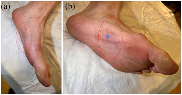 Two clinical projections at twelve months after collagenase treatment
