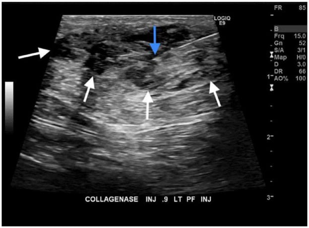 Ultrasound-guided needle placement into a recurrent plantar fibroma