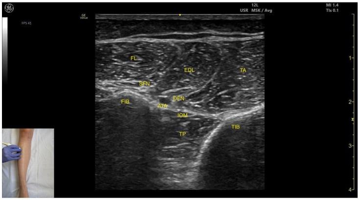 Transverse ultrasound of the anterior leg compartment labelling the tibia, fibula, tibialis anterior, extensor digitorum longus, fibularis longus, superficial fibular nerve, deep fibular nerve and anterior tibial artery