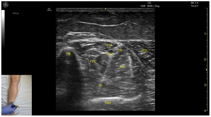 Transverse medial-window ultrasound of the deep posterior leg compartment labelling tibialis posterior, flexor digitorum longus, flexor hallucis longus, tibial nerve and posterior tibial vessels