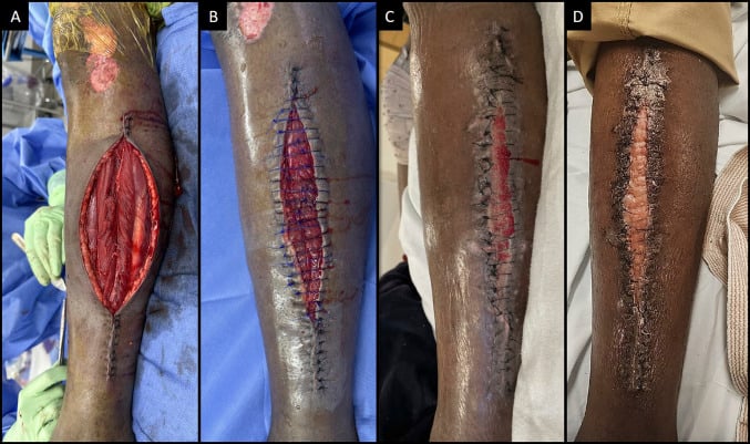 Serial clinical photographs showing an open lateral leg fasciotomy wound followed by staged partial approximation and delayed closure