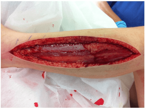 Clinical photograph of a long anterolateral fasciotomy wound of the lower leg exposing muscle
