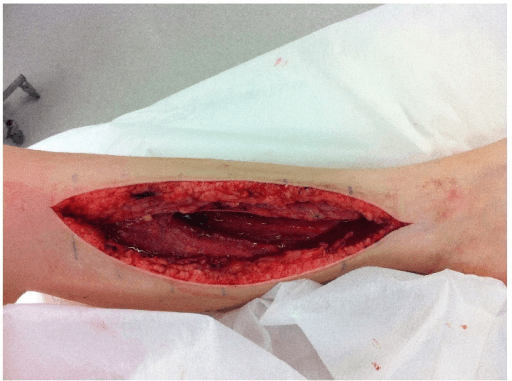 Clinical photograph of a long posteromedial fasciotomy wound of the lower leg exposing muscle